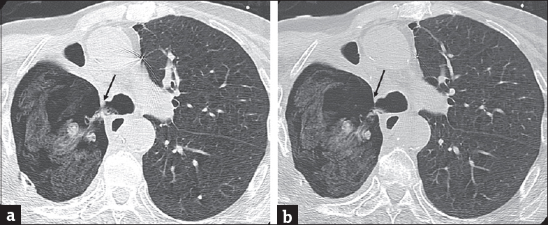 Bronchopleural fistula in a 71-year-old man after right pneumonectomy and Clagett window. (a and b) Axial computed tomography images in lung window demonstrating a fistula between the bronchial stump and pneumonectomy space with herniation of dressing material from the right pneumonectomy space through a fistula into the trachea and left mainstem bronchus (arrow).