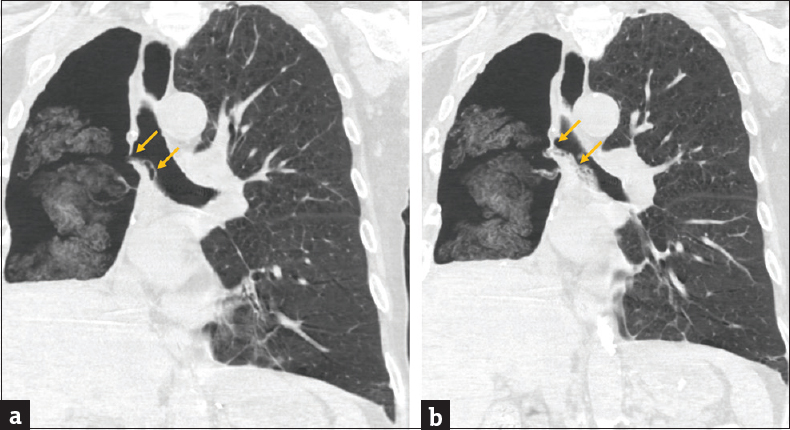 (a and b) Coronal computed tomography images showing a bronchopleural fistula and herniation of dressing material thorough the defect into the carina and left mainstem bronchus (arrows) from the right pneumonectomy space.