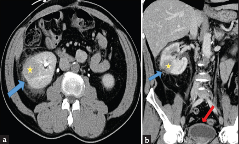 A 49-year-old male with a history of high-grade T1 urothelial cell carcinoma of the bladder undergoing induction bacillus Calmette–Guerin immunotherapy. Initial presentation with fevers and chills after 3 weeks (4 of 6 treatments) of intravesical bacillus Calmette–Guerin therapy. (a) Axial contrast-enhanced computed tomography scan of the abdomen through the level of the kidney showing mass-like low attenuation lesion (yellow star) in the interpolar region of the right kidney with moderate surrounding perinephric inflammatory changes (blue arrow). (b) Coronal reformat contrast-enhanced computed tomography scan of the abdomen and pelvis showing mass-like low attenuation lesion (yellow star) in the interpolar region of the right kidney with moderate surrounding perinephric inflammatory changes (blue arrow). There is also mild diffuse bladder wall thickening (red arrow).