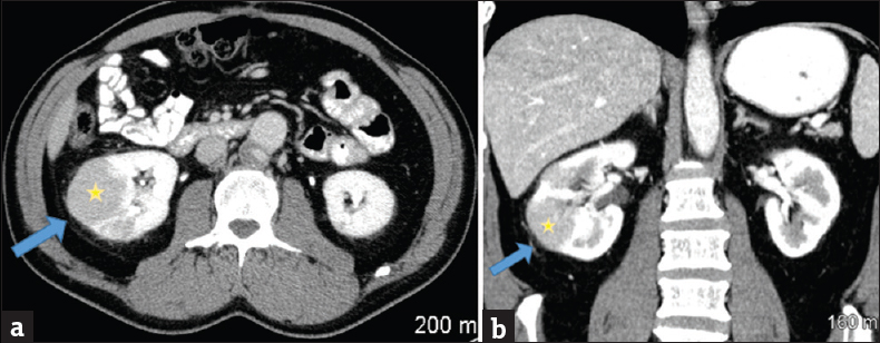 A 49-year-old male with a history of high-grade T1 urothelial cell carcinoma of the bladder undergoing induction bacillus Calmette–Guerin immunotherapy. Initial presentation with fevers and chills after 3 weeks (4 of 6 treatments) of intravesical bacillus Calmette–Guerin therapy. (a) Axial contrast-enhanced computed tomography of the abdomen through the level of the kidneys shows low attenuation lesions (yellow star) in the interpolar region of the right kidney with improving perinephric inflammatory changes 3 weeks later (blue arrow). (b) Coronal reformat contrast-enhanced computed tomography scan through the abdomen showing low attenuation lesions (yellow star) in the interpolar region of the right kidney with improving perinephric inflammatory changes 3 weeks later (blue arrow).