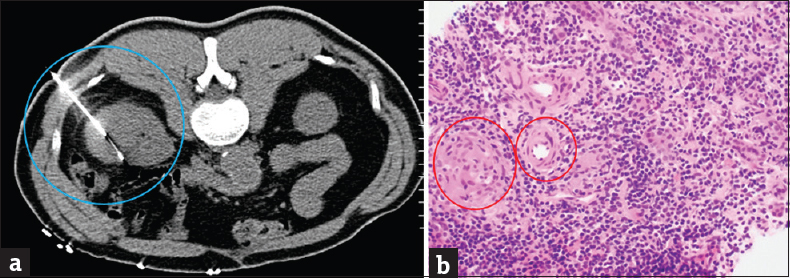 A 49-year-old male with a history of high-grade T1 urothelial cell carcinoma of the bladder undergoing induction bacillus Calmette–Guerin immunotherapy. Initial presentation with fevers and chills after 3 weeks (4 of 6 treatments) of intravesical Bacillus Calmette–Guerin therapy. (a) Axial computed tomography of the abdomen through the level of the kidneys demonstrates a percutaneous computed tomography-guided biopsy of the lesion (blue circle). (b) Core needle biopsy from right renal mass showing marked chronic inflammation with granulomas (red circles). Special stains for acid-fast bacilli (Fite) and fungi (GMS) were negative (not shown).