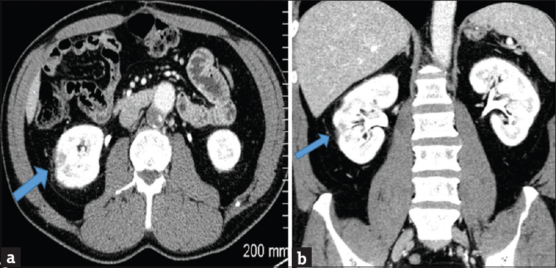 A 49-year-old male with a history of high-grade T1 urothelial cell carcinoma of the bladder undergoing induction bacillus Calmette–Guerin immunotherapy. Initial presentation with fevers and chills after 3 weeks (4 of 6 treatments) of intravesical bacillus Calmette–Guerin therapy. (a) Axial contrast-enhanced computed tomography scan of the abdomen through the level of the kidneys showing interval resolution of the right renal lesions with mild residual cortical scarring 8 months later (blue arrow). (b) Coronal reformat contrast-enhanced computed tomography scan showing interval resolution of the right renal lesions with mild residual cortical scarring 8 months later (blue arrow).