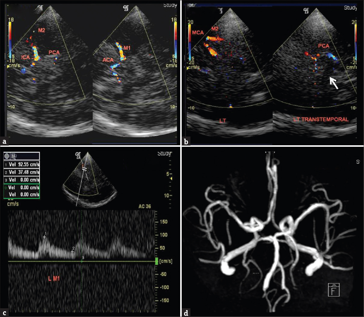 (a) A 65-year-old male with dementia and past stroke. Transcranial color-coded Doppler sonography, right transtemporal insonation demonstrates ipsilateral (dotted lines), M1 and M2 segments of middle cerebral artery, anterior cerebral artery on color display. A 53-year-old female with a history of recurrent stroke. (b) Transcranial color-coded Doppler sonography, left transtemporal insonation shows the normal middle cerebral artery on color display. Posterior cerebral artery is curving around the hypoechoic mesencephalon (white arrow). (c) Left middle cerebral artery spectral waveform shows normal peak systolic velocity and spectrum. (d) Magnetic resonance angiogram showing a normal circle of Willis.