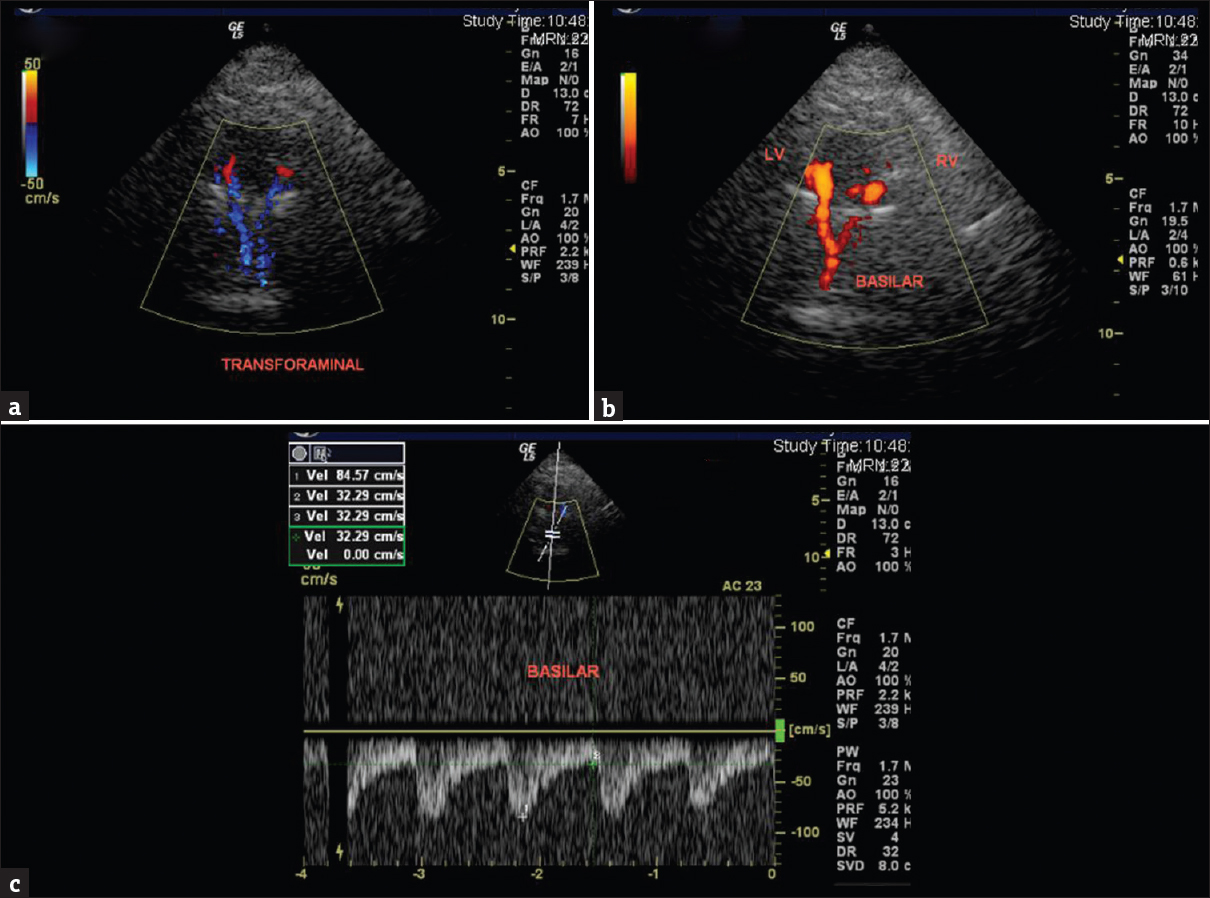 A 47-year-old female with a history of left hemisensory syndrome. (a) Transcranial color-coded Doppler sonography, trans foraminal insonation through nape of the neck color Doppler and (b) power Doppler demonstration of the normal vertebral arteries (marked left vertebral and right vertebral) and proximal basilar artery. (c) Spectral waveform in proximal basilar artery shows normal peak systolic velocity and spectral pattern.