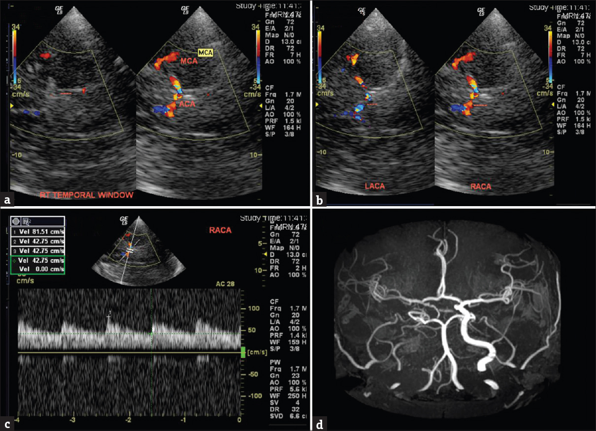 A 37-year-old male with a history of progressive vision loss on the right (a) transcranial color-coded Doppler sonography, right transtemporal insonation shows absence of color flow in the right terminal internal carotid artery (dotted lines) suggestive of occlusion. (b) Transcranial color-coded Doppler sonography, left and right transtemporal insonation showing normal left anterior cerebral artery in blue (dotted lines on the left) and red-coded right anterior cerebral artery (dotted lines on the right) suggesting reversed flow toward the probe. (c) Spectral Doppler of right anterior cerebral artery shows waveform above the baseline in keeping with collateralization. (d) Magnetic resonance angiogram shows right internal carotid artery occlusion and reformed middle cerebral artery through collaterals.