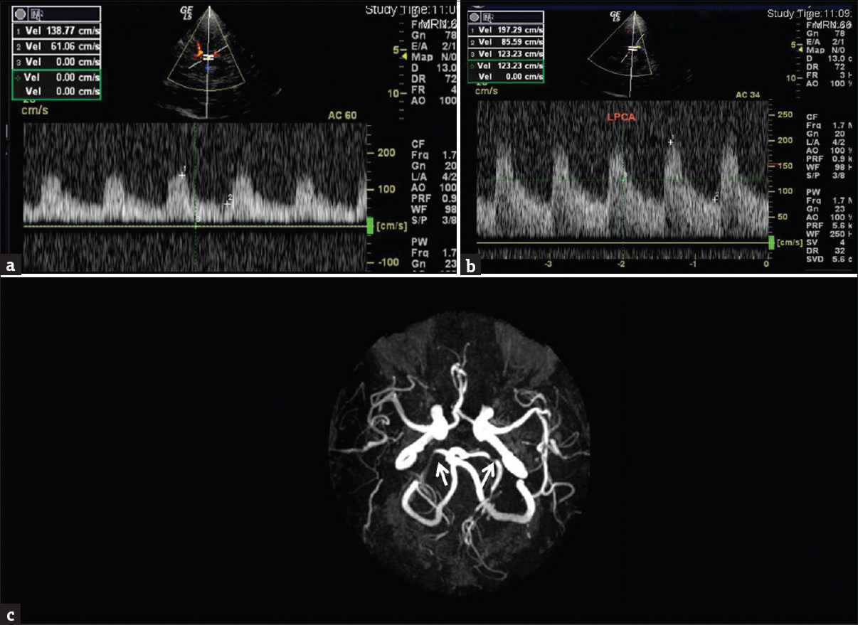 A 61-year-old male with a history of residual left spastic hemiparesis after a previous episode of stroke. (a) Transcranial color-coded Doppler sonography, transtemporal insonation with spectral display from right posterior cerebral artery and (b) left posterior cerebral artery showing increased peak systolic velocity, left more than right. (c) Magnetic resonance angiogram showing significant stenosis of bilateral posterior cerebral artery (white arrows).