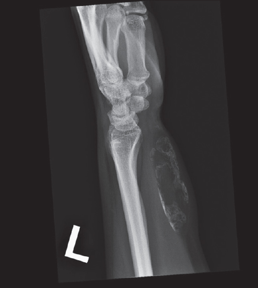 Lateral x-ray of the left wrist shows a mass with internal calcifications at volar aspect of left distal forearm. The low density of the lesion on radiograph likely signifies a lesion that is fat-predominant.