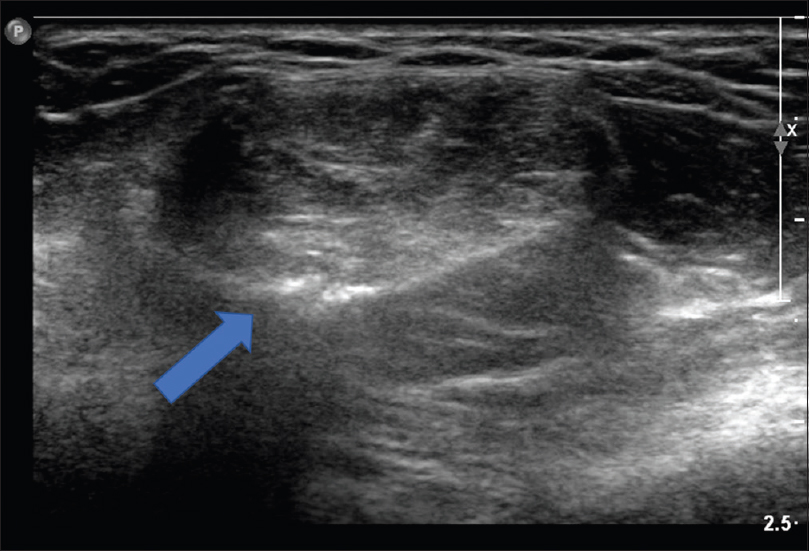 Ultrasound reveals a spheroid hyperechoic lesion with internal heterogeneity. A continuous hyperechoic rim with posterior shadowing is present, suggestive of calcifications, and is in keeping with x-ray findings.