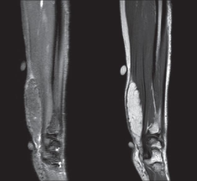 MRI T2-weighted fat suppressed sequence (left) and T1-weighted sequence (right). A well-demarcated T1 hyperintense lesion is noted compressing on the flexor digitorum superficialis and flexor carpi radialis muscles. The lesion shows fat suppression.