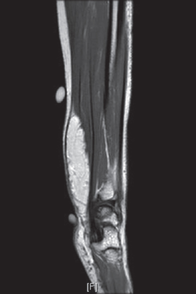 MRI examination with T1-weighted post-gadolinium sequence in sagittal view. The fat-contaning lesion shows no significant contrast enhancement. No invasion into adjacent muscles detected.