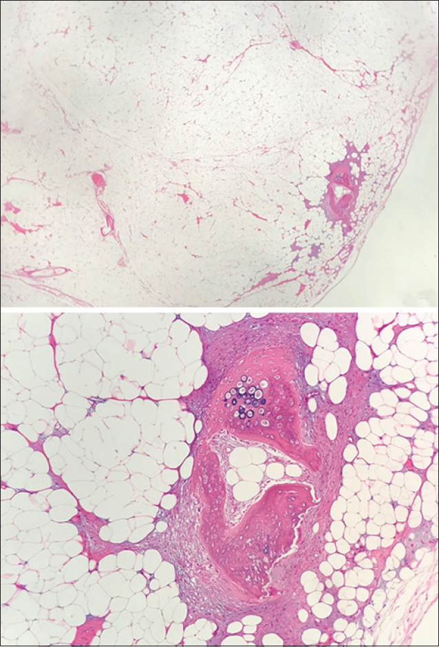 Histological views of the osteolipoma. The tumour consists of adipose tissues with a few foci of ossification. Lipoblasts are not present and there is no feature of malignancy.