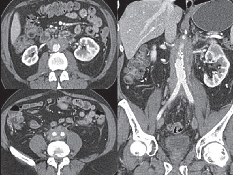 Selected axial and coronal contrast-enhanced computed tomography images of the retroperitoneal fibrosis which is isoattenuating to muscle showing some subtle postcontrast enhancement. It is surrounding but not lifting the aorta. Computed tomography is the initial investigation of choice in the most cases to assess for retroperitoneal fibrosis due its accessibility and ability to evaluate the location and extent of the organ involvement.