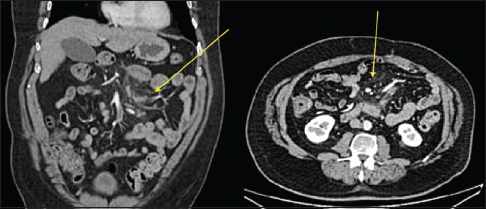 Axial and coronal contrast-enhanced computed tomography image of early mesenteric panniculitis. There is an increased attenuation (fat stranding) within the bowel mesentery with sparing of the fat surrounding mesenteric vessels and small lymph nodes (yellow arrows). The fat stranding is relatively well circumscribed and limited to the mesentery.