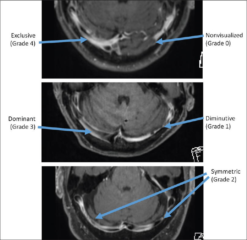 Grading system used for the transverse and sigmoid sinuses, to assess correlation with ipsilateral inferior petrosal sinus grade.