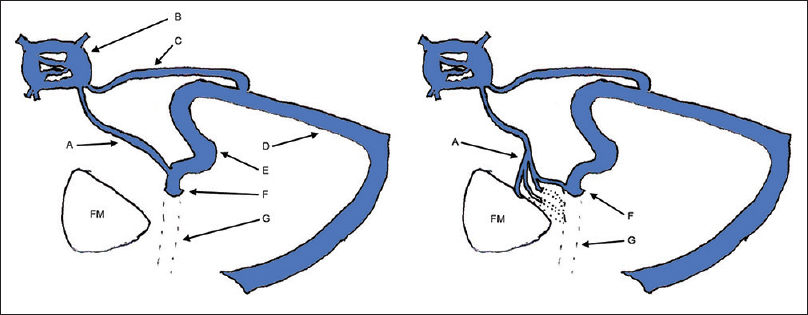 Typical (left) and atypical (right) drainage patterns of the inferior petrosal sinus. (A) Inferior petrosal sinus. (B) Cavernous sinus. (C) Superior petrosal sinus. (D) Transverse sinus. (E) Sigmoid sinus. (F) Jugular bulb. (G) Internal jugular vein. FM: Foramen magnum.