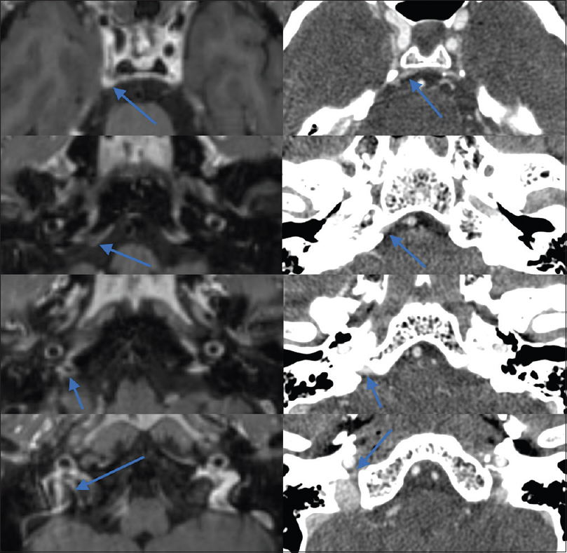 Appearance of a grade 2 (fully visualized) right inferior petrosal sinus with drainage pattern of type A in the same patient on both contrast-enhanced T1-weighted magnetic resonance imaging (left) and computed tomography venography (right).