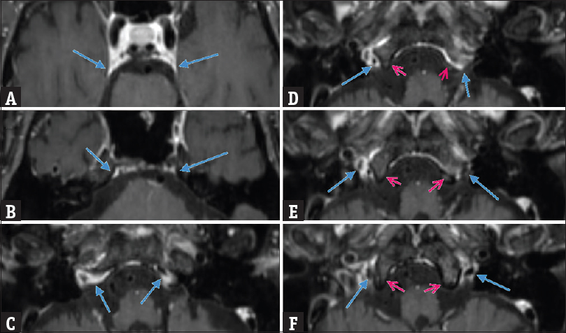 Asymmetrical bilateral inferior petrosal sinuses as they course from the cavernous sinus to the skull base (A through F). The right inferior petrosal sinus demonstrates type A drainage, while the left inferior petrosal sinus demonstrates type B drainage. Frames D and E show the left inferior petrosal sinus (blue arrow) passing through the bony clivus (red arrow) rather than draining directly into the jugular bulb