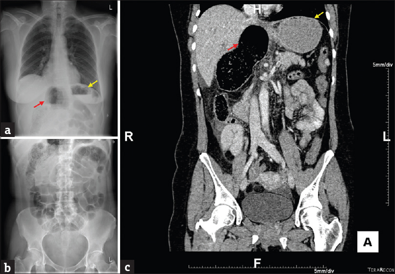 A 59-year-old Caucasian female presents with epigastric pain, jaundice, vomiting and constipation. (a) Erect chest radiograph reveals dilated hollow viscus (yellow arrow) beside the stomach (red arrow). (b) Abdominal radiograph shows multiple prominent loops of small bowel. (c) Coronal view of computed tomography abdomen and pelvis shows the dilated cecal pole within the lesser sac, corresponding with the radiographic findings.