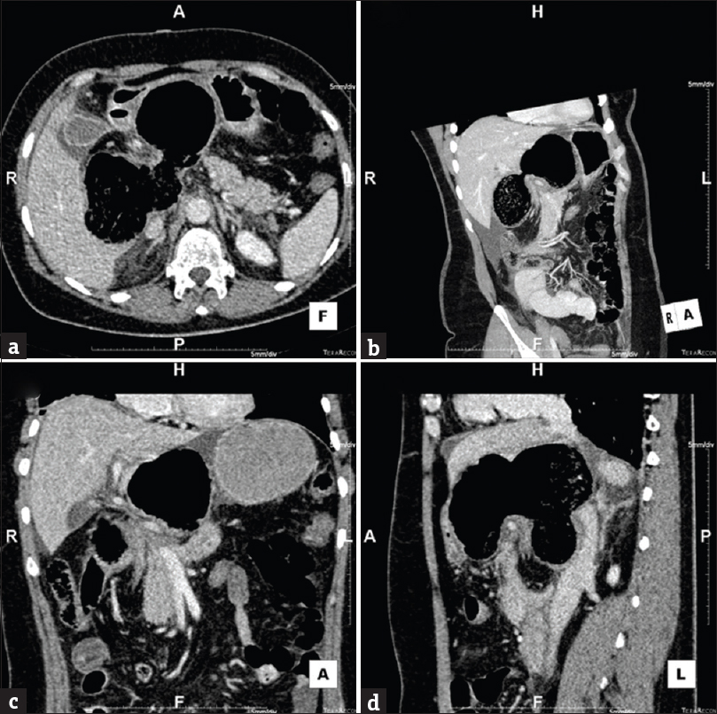 Multiple planes of computed tomography depicting the twisted, herniated cecum within the lesser sac. Reconstructed images: (a) axial, (b) oblique coronal, (c) coronal, and (d) sagittal views.