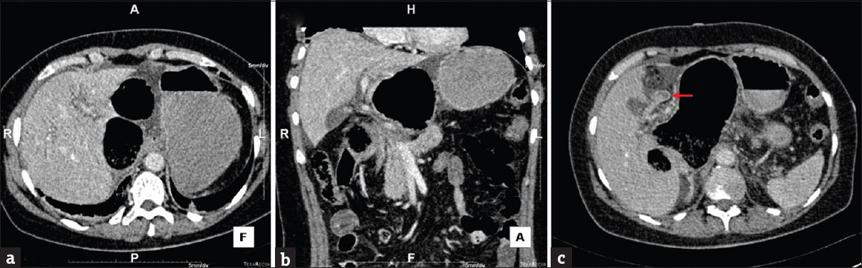 Computed tomography abdomen showing (a) axial view and (b) coronal view of intrahepatic ductal dilatation resulting from pressure on the biliary tree. Also note surrounding ductal edema and fluid in the gallbladder fossa. (c) Axial view showing sharp angulation of the cystic duct (red arrow).