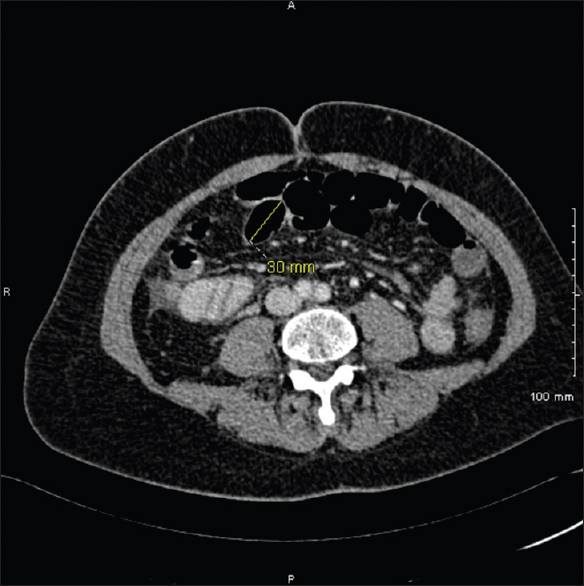 Axial computed tomography of the mid abdomen showing small bowel calibre at the upper limit of normal.