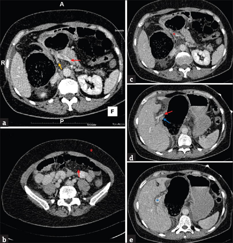 Multiple axial views of the abdomen on computed tomography. (a) Evidence of thrombosis at the confluence of the splenic vein (red) and the superior mesenteric vein (orange). (b) Misty mesenteric fat (arrow) as compared to normal peripheral fat (asterisk), confirming a degree of thrombosis within the portal venous system. (c) Disappearance of the confluence (asterisk) at the proximal portion of the hepatic portal vein. (d) Depiction of the hepatic hilum showing the hepatic arteries (red) and the re-emergence of the hepatic portal vein (blue). (e) Complete re-emergence of the hepatic portal vein beyond the hepatic hilum (asterisk).