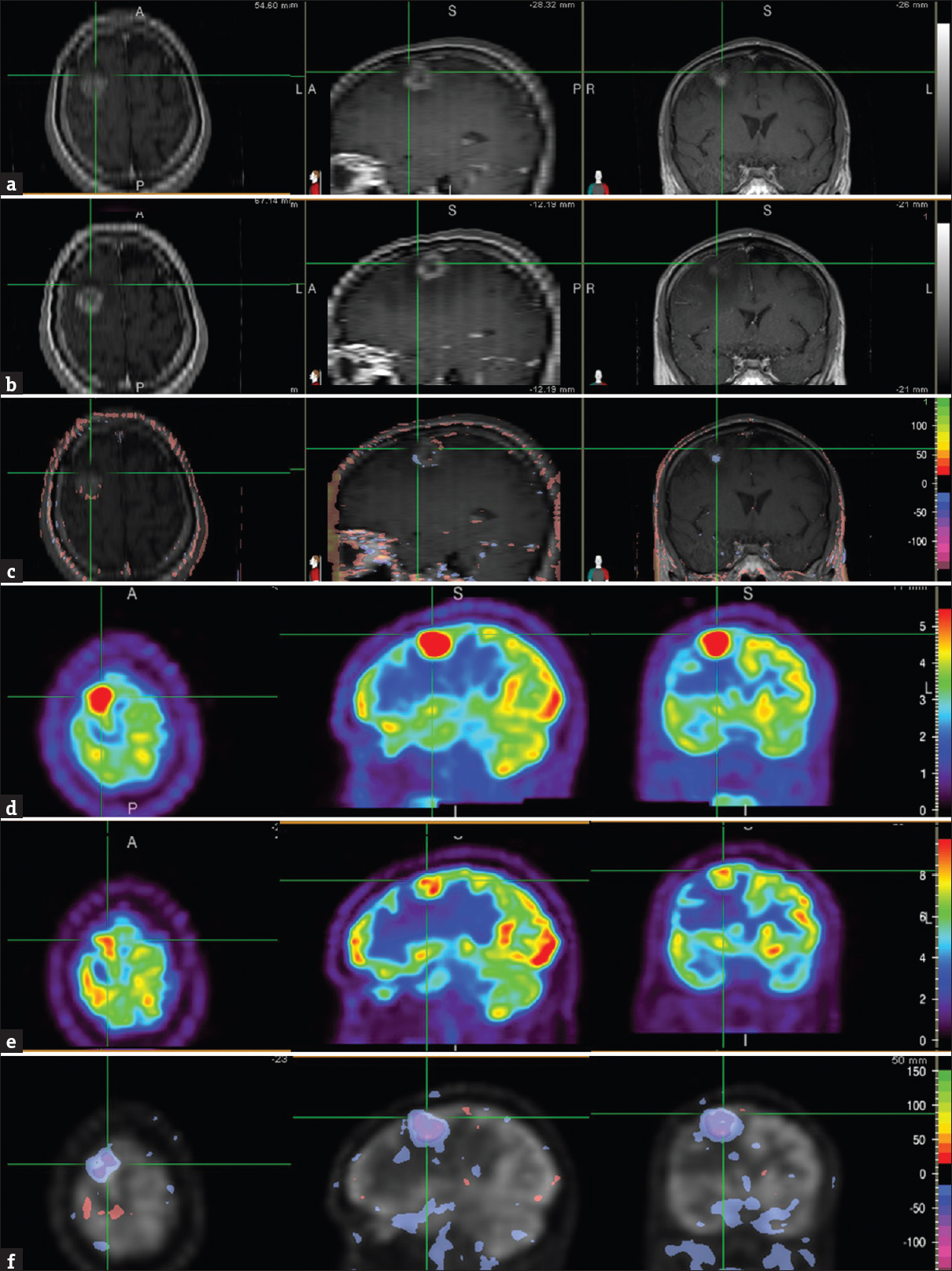 A 60-year-old Caucasian male presented with a left-sided weakness including dragging his left foot, and the inability to write for about 6 weeks. Brain magnetic resonance imaging showed a solitary 2.3 cm brain lesion in the right frontal lobe, and subsequent positron emission tomography/computed tomography study showed multiple fludeoxyglucose avid bilateral pulmonary nodules and mediastinal adenopathy. Biopsy of a mediastinal lymph node revealed metastatic adenocarcinoma, negative for epidermal growth factor receptor mutation. Brain magnetic resonance images, T1-weighted contrast-enhanced (axial = left image; sagittal = middle image; coronal = right image), before (a) and 1 month after stereotactic radiosurgery (b) showed the right frontal lobe metastasis (cross-hair). Normalized subtraction result of A and B overlaid with the magnetic resonance image (c), demonstrated small areas of mixed interval decrease (purple) and increase (orange-red) of contrast enhancement, and other areas with no interval change. Corresponding fludeoxyglucose positron emission tomography scans (axial = left image; sagittal = middle image; coronal = right image) before (d) and 1 month (e) after stereotactic radiosurgery showed the brain metastasis (cross-hair). NS result of D and E, overlaid with the positron emission tomography image (f), showed interval decrease (purple) in lesional fludeoxyglucose uptake. The residual uptake, however, was still greater than that in the surrounding and contralateral brain parenchyma suggestive of partial treatment response.