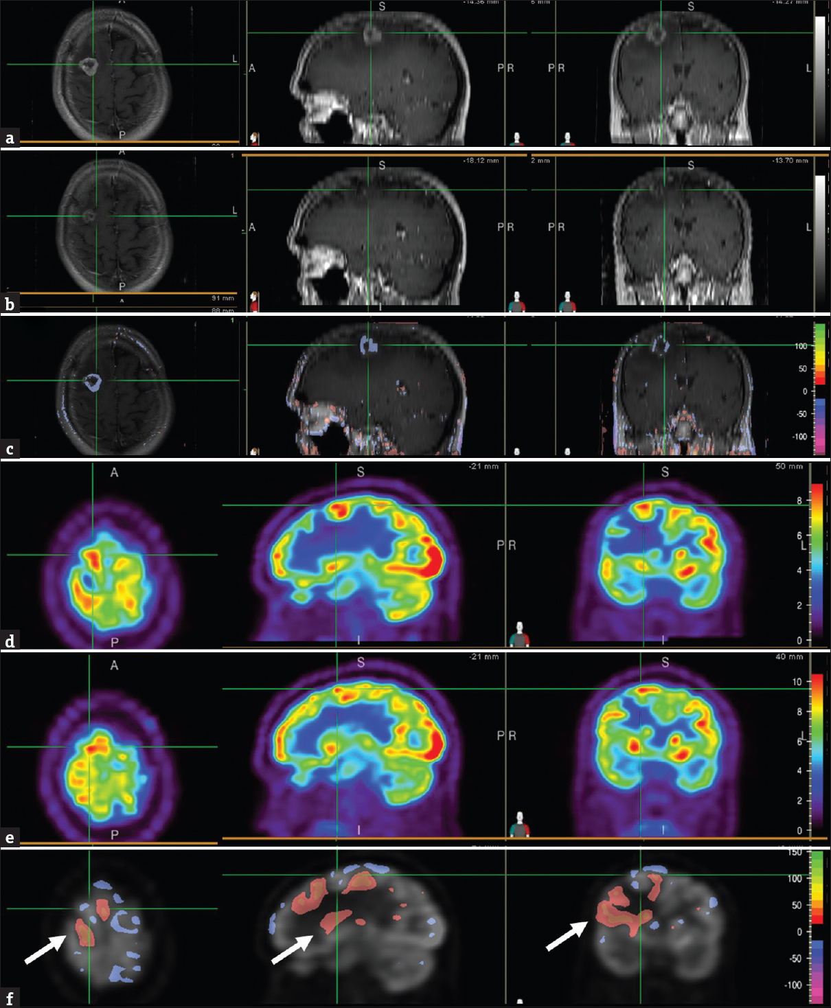 Brain magnetic resonance images, T1-weighted contrast-enhanced, at 1 month (a) and 7 months (b) after stereotactic radiosurgery showed the area of the right frontal brain lesion (cross-hair). Normalized subtraction result of A and B, overlaid with the magnetic resonance image (c), showed marked decrease in the signal intensity and size of the ring enhancement. Corresponding positron emission tomography images at 1 month (d) and 7 months (e) after stereotactic radiosurgery showed the area of the right frontal lesion (cross-hair). Normalized subtraction result overlaid with positron emission tomography image (f) demonstrated small areas of mild interval decreased uptake (purple) within the brain lesion and other areas with no interval change. Given the residual fludeoxyglucose avidity compared to the surrounding and contralateral brain parenchyma, residual tumor was suspected. Interval increased (orange-red) uptake in brain tissue surrounding the tumor lesion reflected metabolic recovery and improving vasogenic edema (F, arrow).