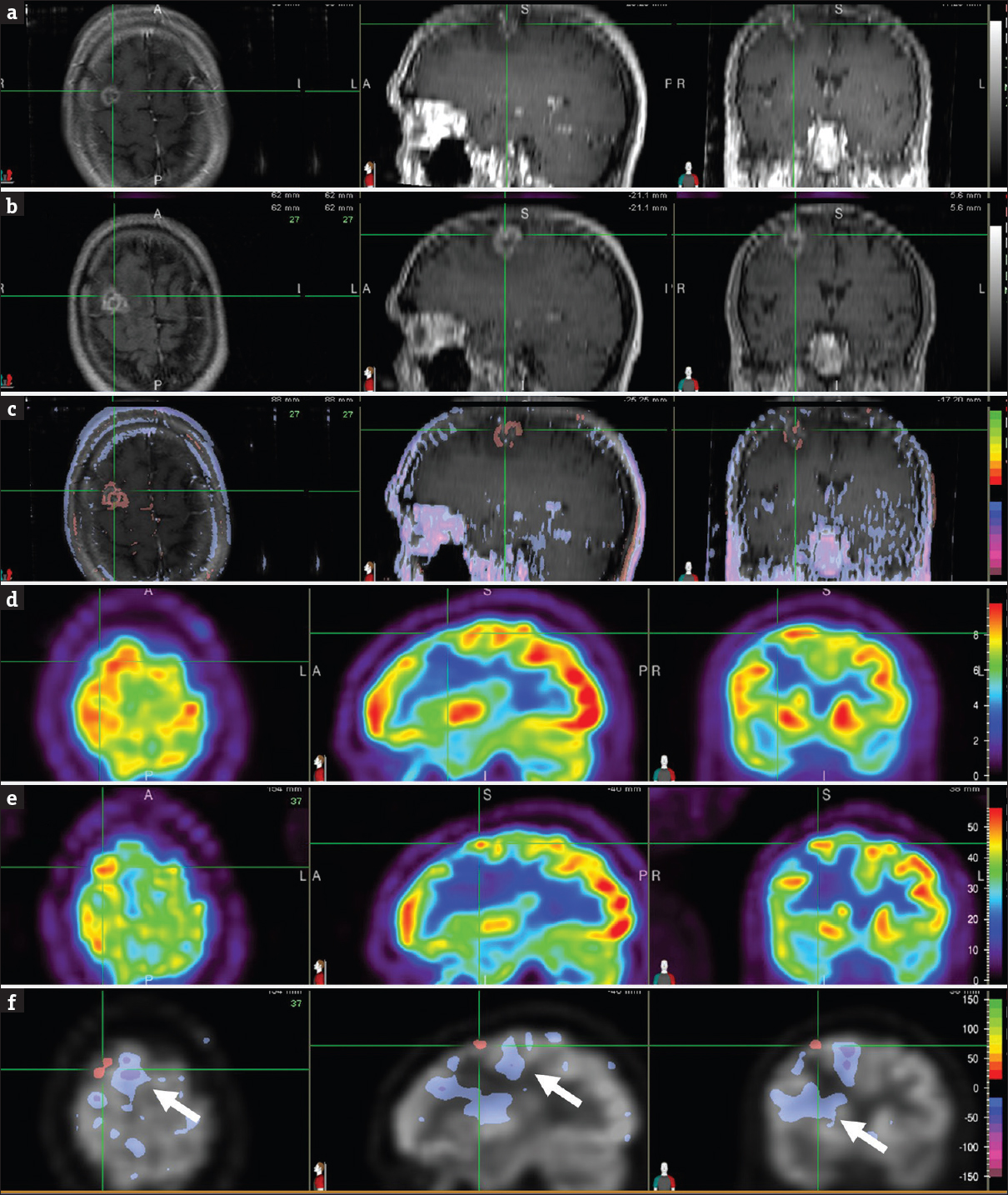 Brain magnetic resonance images, T1-weighted contrast-enhanced, at 7 months (a) and 17 months (b) after stereotactic radiosurgery focused on the right frontal lesion (cross-hair). Normalized subtraction result, overlaid with the magnetic resonance image (c), demonstrated interval increase (orange-red) in signal intensity and size of the contrast enhancing lesion. Corresponding positron emission tomography images at 7 months (d) and 17 months (e) after stereotactic radiosurgery focused on the right frontal lesion (cross-hair). Normalized subtraction result, overlaid with the positron emission tomography image (f), showed interval increased (orange-red) fludeoxyglucose uptake within the tumor bed suspicious for tumor recurrence. Interval decreased (purple) uptake in brain areas surrounding the tumor (F, arrow) represented metabolic dysfunction due to vasogenic edema associated with tumor recurrence. Subsequent proton magnetic resonance spectroscopy was also suspicious for recurrent tumor, so a tissue sampling was foregone. The patient was retreated again with Still Birth Rate in a single dose of 21 Gy. Although the patient remained free of neurologic symptoms, the lesion size progressed on follow-up magnetic resonance imaging scans. A biopsy was positive for residual metastasis, and subsequent surgical resection of the lesion revealed metastatic tumor and an additional area of increased secondary to radiation treatment effect.