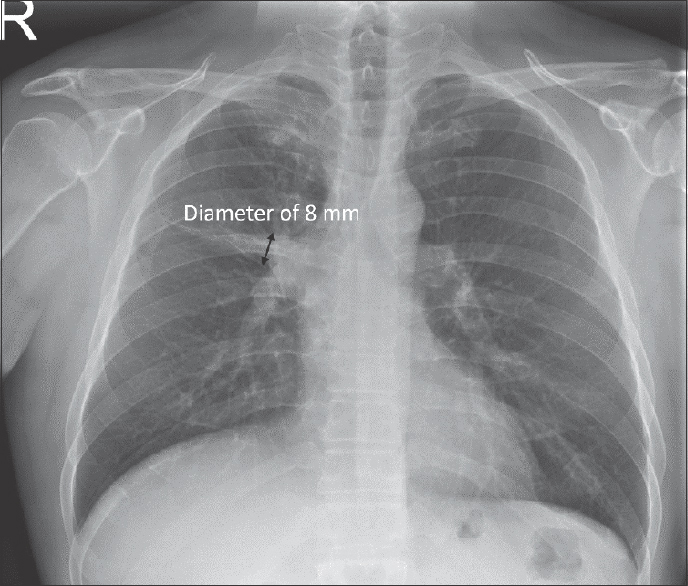 What does this mean on a chest x-ray