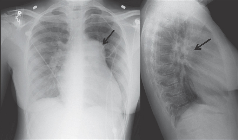 A 39-year-old female with a history of congenital heart disease, which included atrial septal defect and right pulmonary artery stenosis. The patient underwent atrial septal defect repair and angioplasty of the pulmonary artery. Pulmonary artery and lateral radiographs of the chest show enlargement of the pulmonary trunk and left pulmonary artery (black arrow) in a patient with congenital pulmonary artery stenosis.