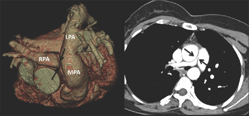 The same patient as in Figure 1. 3D reconstruction and axial computed tomography angiogram shows severe short-segment discrete narrowing of the proximal right pulmonary artery (black arrows).