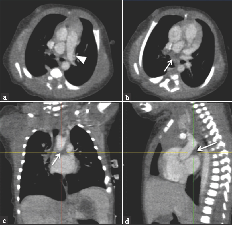 A 3-day-old female with a history of cardiac abnormalities and symptomatic respiratory distress. Computed tomography angiogram images (a and b) are selected axial images, (c) is a coronal reconstruction, and (d) is a sagittal reconstruction. The main and left pulmonary artery opacify with contrast (white arrowhead). The right pulmonary artery is absent (white arrows demonstrate expected location). No large major aortopulmonary collateral arteries from the aorta or major branch vessel was identified in this patient. There is an incidental azygous lobe noted in the right lung.