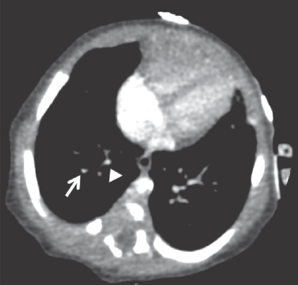 Computed tomography angiogram [same patient as Figure 3] demonstrating poor contrast opacification of the distal right pulmonary artery in the right lower lobe (white arrow). The right pulmonary veins are also small in caliber (white arrowhead).