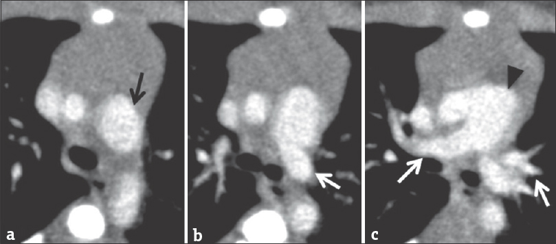 A 5-day-old term infant with prenatal concern for truncal abnormality. Axial images [Figure 5a to c] from a cardiac computed tomography angiogram demonstrating Type I truncus arteriosus with arch interruption. The aorta (black arrow) and main pulmonary artery (white arrow) are shown to arise from a common trunk (black arrowhead). The branch pulmonary arteries both arise from the posterior aspect of the common trunk (white arrows).