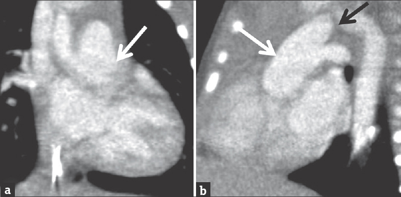 Coronal (a) and sagittal (b) reconstructions from the same computed tomography angiogram of the chest presented in Figure 5. The common trunk of aorta and main pulmonary artery (white arrow) are demonstrated as well as interruption of the aortic arch proximal to the origin of the left subclavian artery (black arrow).