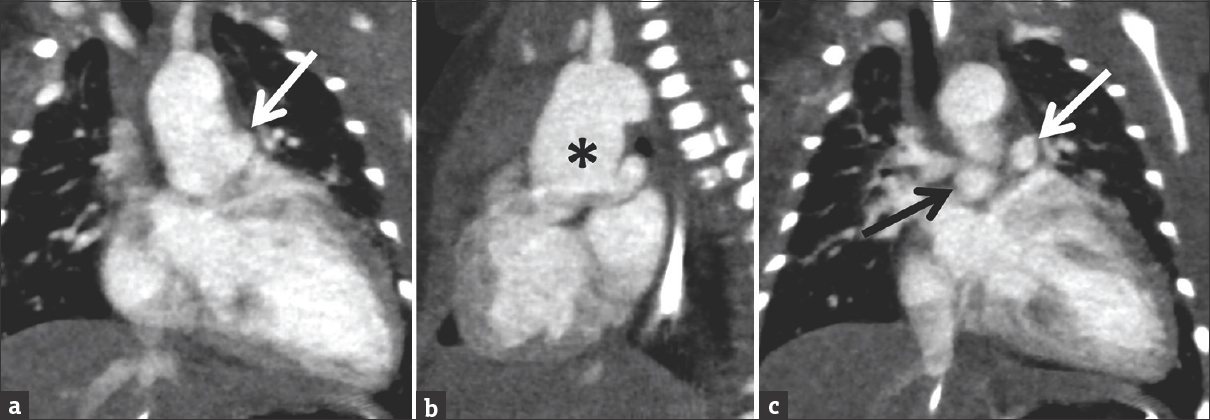 Coronal images from a cardiac computed tomography angiogram in a 7-day-old male with Type II truncus arteriosus which was suspected on echocardiography. There is a dilated ascending aorta (black asterisk) with the branch pulmonary arteries arising separately from the posterior wall of the ascending aorta (right pulmonary artery = black arrow; left pulmonary artery = white arrow).