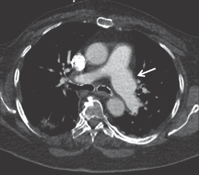 A 31-year-old patient with suspected connective tissue disorder. Axial computed tomography angiogram image from a young adult patient shows idiopathic dilatation of the left pulmonary artery (white arrow) with normal caliber main and right pulmonary artery.