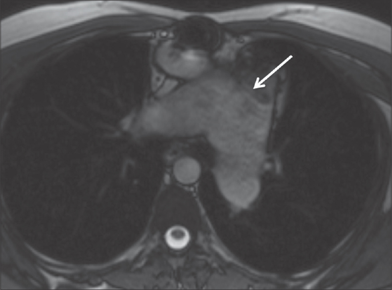 Axial true fast imaging with steady-state free precession from the same patient in Figure 8 showing dilated main pulmonary artery (white arrow) which measured up to 6.4 cm in diameter. The branch pulmonary arteries are also dilated.