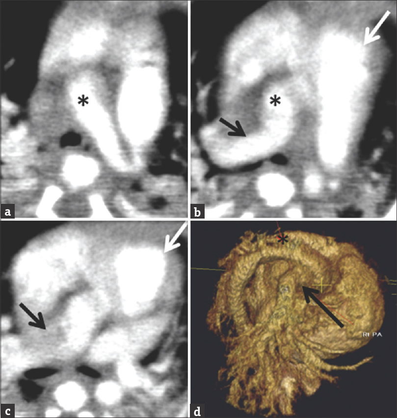 Axial images and 3D reconstruction of the heart from a cardiac computed tomography angiogram in a 6-day-old male. The right pulmonary artery (black arrow) arising from the ascending aorta. The main pulmonary artery (white arrow) is separate from the aorta (black asterisk). The left pulmonary artery arises from the main pulmonary artery.