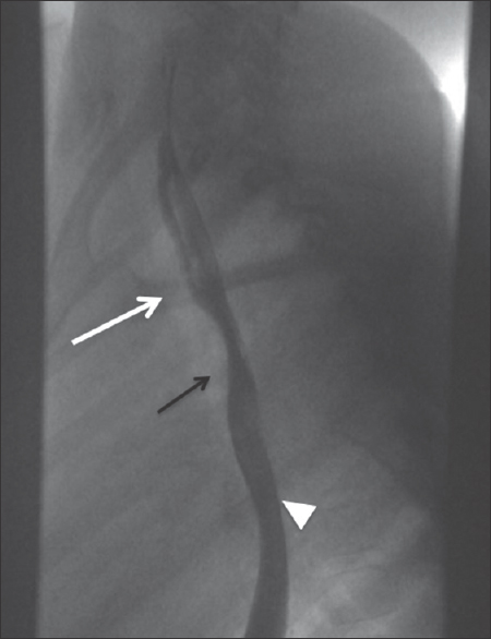 Lateral esophagram on a patient with upper airway symptoms demonstrates an anterior impression, which can be seen with underlying anomalous left pulmonary artery (black arrow) between the airway (white arrow, outlined by an air column) and esophagus (white arrowhead).