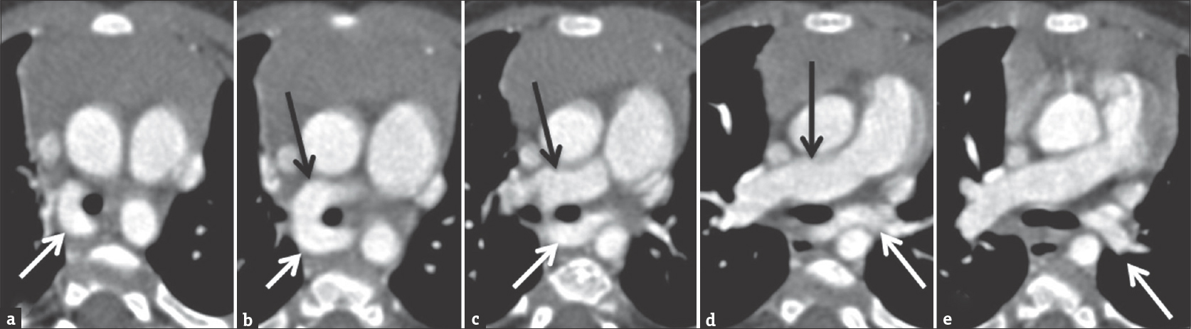 Computed tomography angiogram of a 9-month-old male with prenatal concern for complex congenital heart disease and suspected left pulmonary sling on echocardiogram. Figures 12a to e are selected axial images demonstrating the anomalous origin of the left pulmonary artery (white arrow) from the right pulmonary artery (black arrow) as well as the abnormal posterior course of left pulmonary artery behind the trachea.