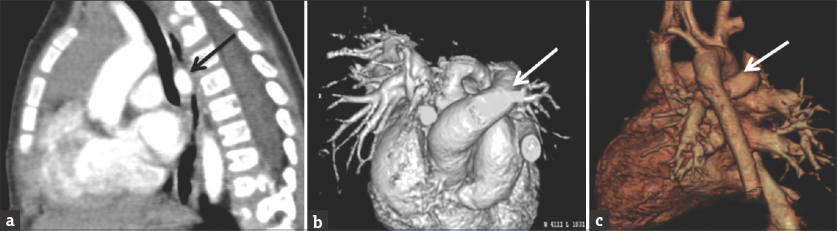 Images from the same patient in Figure 13. Computed tomography angiogram shows the aberrant left pulmonary artery (black and white arrows) courses between the lower trachea and the mid-esophagus causing moderate tracheal stenosis. Figure 13b and c are 3D reconstructions of the computed tomography angiogram better demonstrating the pulmonary sling.