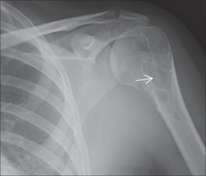 A 17-year-old girl with neurofibromatosis who presented with pain in the left shoulder. Plain radiograph of the left shoulder anteroposterior view showing multilocular osteolytic lesion (arrow) in the left humerus involving metaphysis and upper shaft with sclerotic margins.