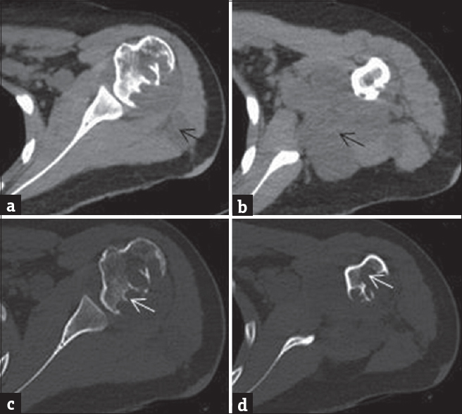 A 17-year-old girl with neurofibromatosis who presented with pain in the left shoulder. (a and b) Plain computed tomography image of the left shoulder in soft-tissue window shows hypodense soft-tissue density mass with lobulated outlines (black arrow) in the left axilla extending in intermuscular fat planes suggestive of plexiform neurofibroma. (c and d) computed tomography image with bony window shows multilocular osteolytic lesions with sclerotic margins (white arrow) in adjoining humeral head and upper shaft suggestive of intraosseous neurofibroma.