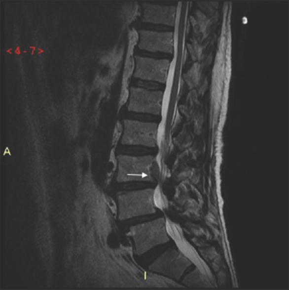 A 45-year-old male who presented with low back pain radiating to the lower extremity. Sagittal T2-weighted magnetic resonance imaging of the lumbar spine demonstrates a disk herniation arising from the L3-4 level with cephalad migration posterior to the L3 vertebral body (white arrow).