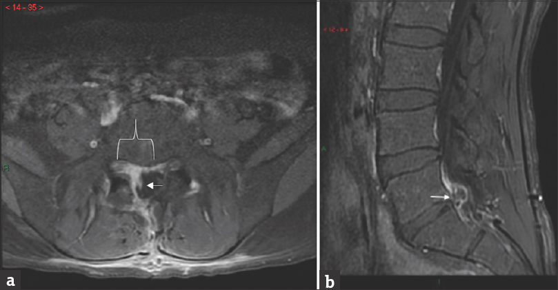 (a) A 25-year-old male complained of worsening L1 distribution radiculopathy symptoms 1 day after microdiskectomy. Axial T1 fat saturated image of the lumbar spine with contrast demonstrates homogenously enhancing tissue in the right subarticular recess (white bracket) which represents granulation tissue. The traversing right S1 nerve root (white arrow) is enhancing and was likely injured during surgery. (b) A 32-year-old male complained of worsening right lower extremity radiculopathy symptoms for one year after previous microdiskectomy for similar radicular symptoms. A Sagittal T1 fat saturated image of the lumbar spine with contrast demonstrates a residual/recurrent disk herniation at the L5-S1 level (white arrow) resulting in residual lumbosacral radiculopathy symptoms. The disk herniation was confirmed during repeat surgery.