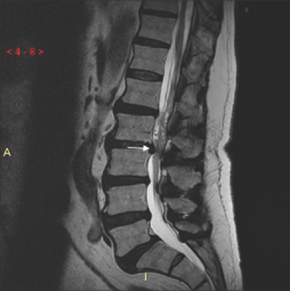 A 43-year-old woman complained of progressive chronic low back pain which worsened when walking short distances. A sagittal T2-weighted image of the lumbar spine demonstrates a disk herniation at L2-3 (white arrow) resulting in severe spinal canal stenosis.