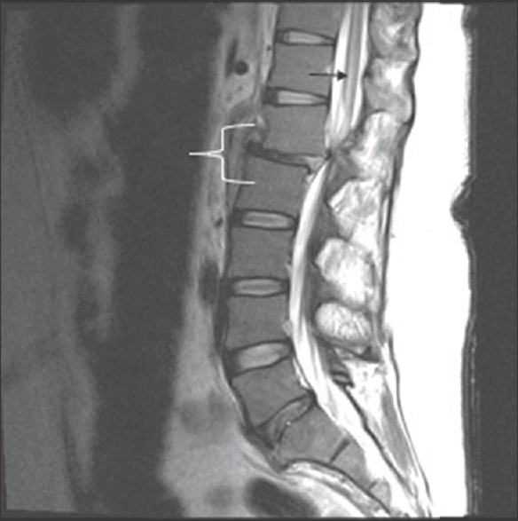 A 24-year-old male presented with bilateral lower extremity paralysis and loss of sensation after a motor vehicle collision. A sagittal T2-weighted image demonstrates traumatic retrolisthesis of L1 on L2 (white bracket) resulting in severe canal stenosis. Note the hyperintense T2 signal in the spinal cord which represents a spinal cord infarction (black arrow).