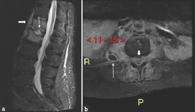 (a) A 42-year-old male with a history of intravenous drug use presented with fever and low back pain. A sagittal short tau inversion recovery magnetic resonance imaging of the lumbar spine demonstrates edema-like signal in the L1 and L2 vertebral bodies with fluid signal within the intervertebral disk space and endplate destruction (thin arrow). Note the paraspinal phlegmon (thick white arrow). (b) A 43-year-old female presented with fever, severe low back pain, and bilateral lower extremity weakness. Axial T1 fat, saturated magnetic resonance imaging with gadolinium of the lumbar spine demonstrates a paraspanal abscess (thin white arrow) as well as epidural phlegmon and abscess (short, thick white arrow) in the lumbar spine.